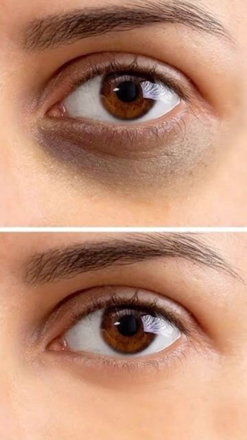 Under-eye Dark Circle Treatment